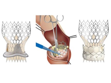 Nitinol Wire Enhances Flexibility in Orthopedic Bone Implants