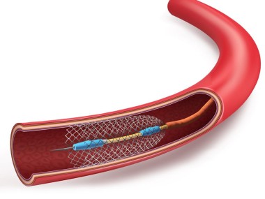 Medical Grade Nickel Titanium Wire Superelastic for Implants