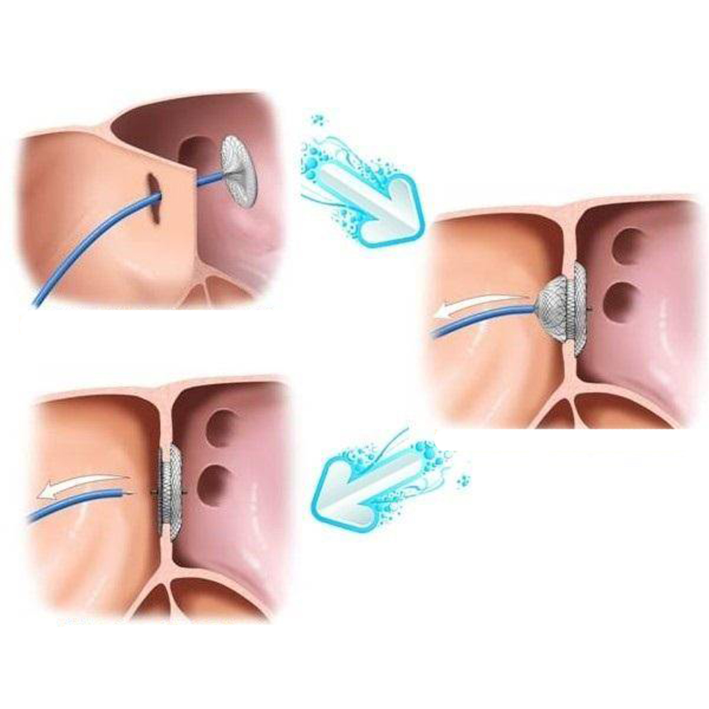 The Ultimate Guide to Nitinol Wire for Your Business