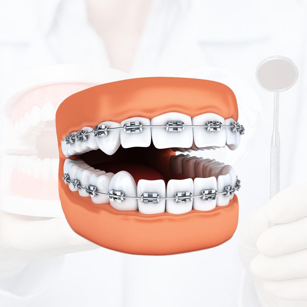 Why Nitinol Wire Is the Best Choice for Orthodontic Treatment Why Nitinol Wire Is the Best Choice for Orthodontic Treatment