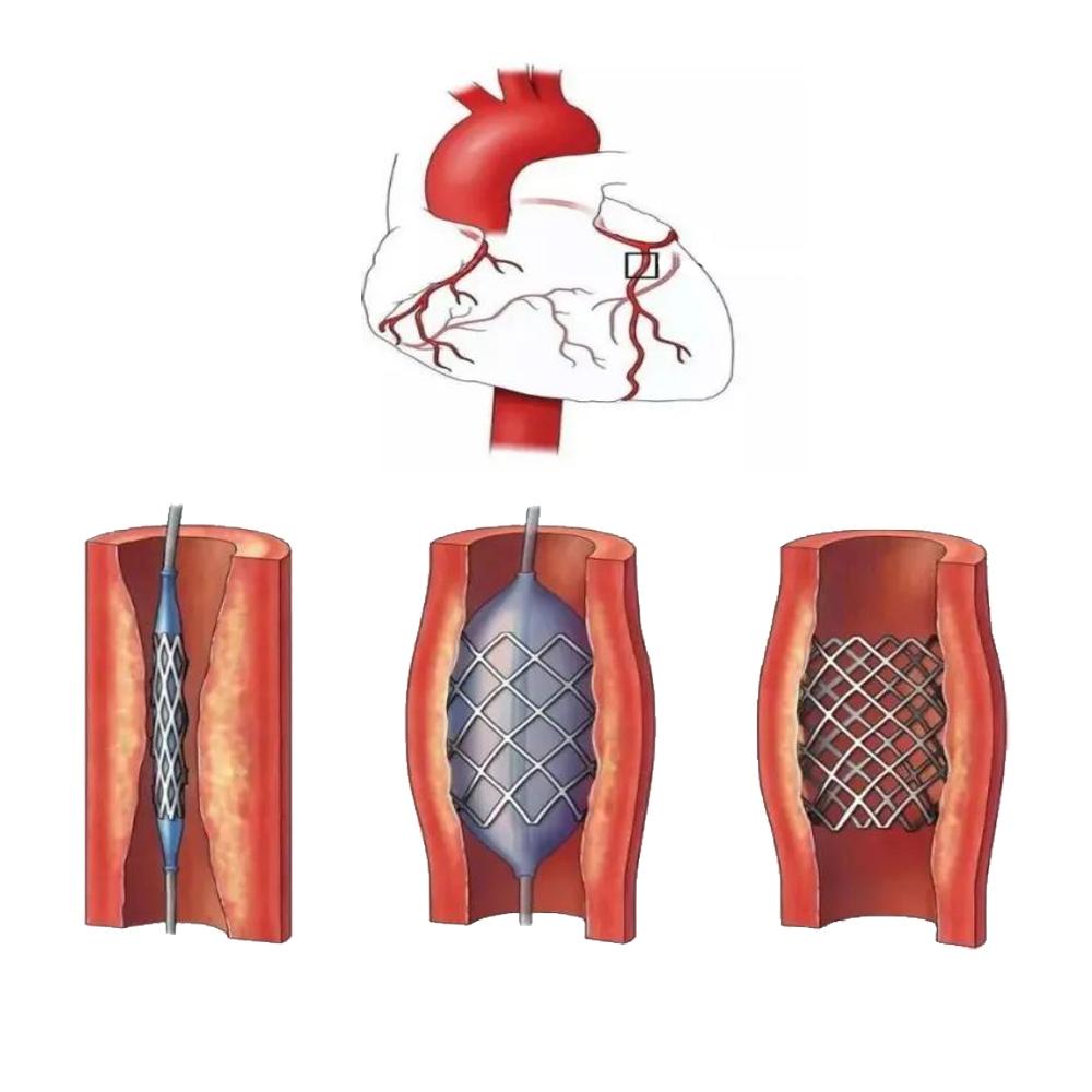 Premium Superelastic Nitinol Wire for Minimally Invasive Surgery