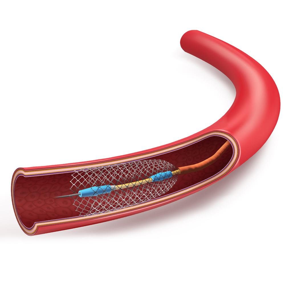 Premium Superelastic Nitinol Wire for Minimally Invasive Surgery Premium Superelastic Nitinol Wire for Minimally Invasive Surgery