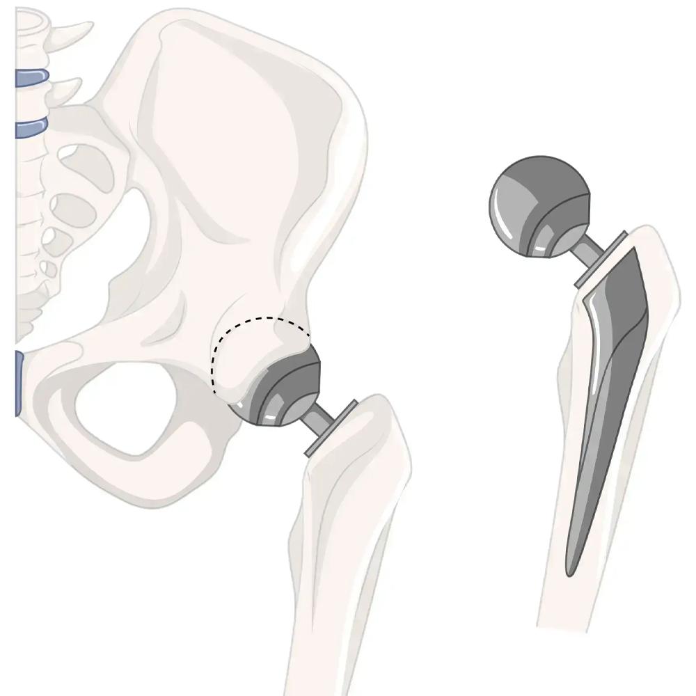 Nitinol Wire Enhances Flexibility in Orthopedic Bone Implants